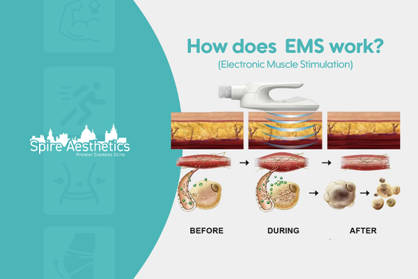 EMS treatment for post pregnancy weight loss treatment Wakefield