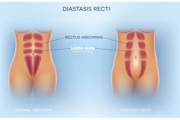 How Does Non-Surgical Treatment Help With Loose Skin, Weak Abdominal Muscles and Post-Pregnancy Changes Wakefield?
