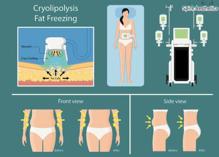 Image of diet and fat freezing combined for best results for Spire Aesthetics Wakefield