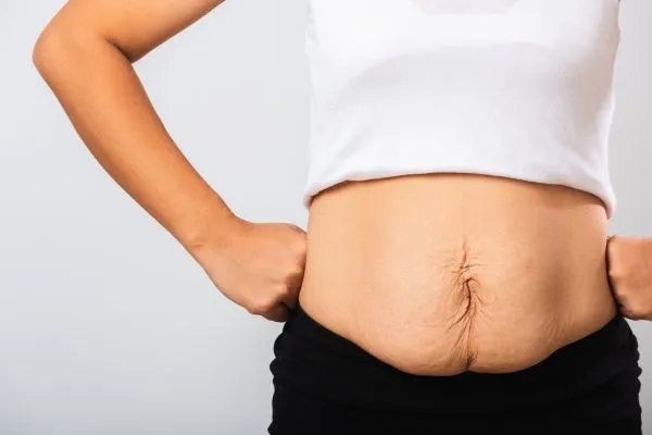 Image of a woman's stomach after weight loss with sagging skin following a gastric band Wakefield