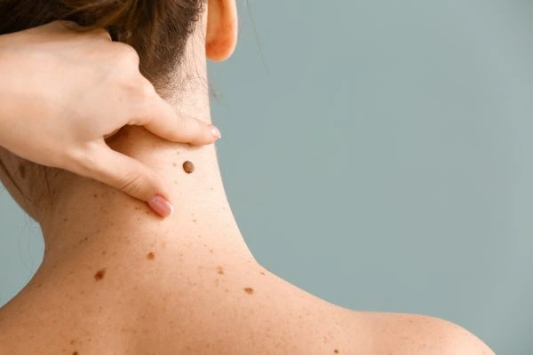 Prices and promotions for blemish removal Wakefield contact our team today!