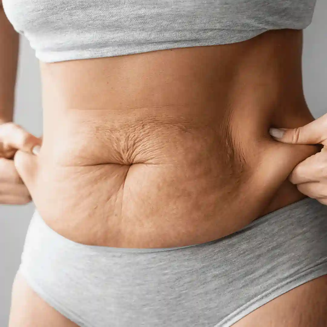 Is It Normal to Have Loose Skin After Pregnancy Wakefield?