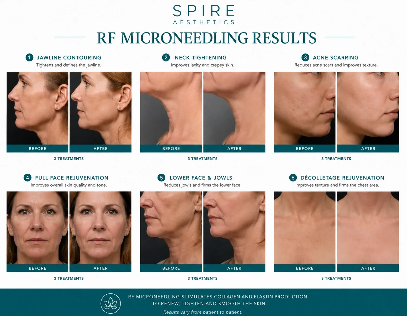 RF Microneedling Skin tightening Wakefield results