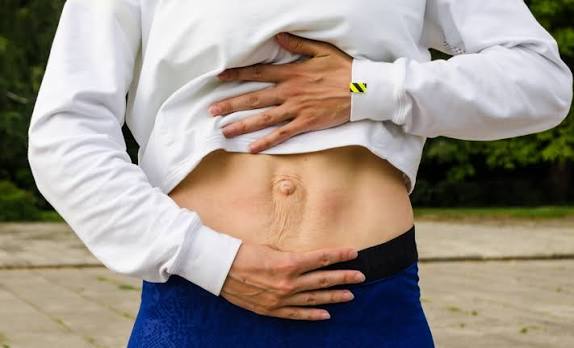 When Could Diastasis Recti Be the Missing Piece of the Puzzle Wakefield?