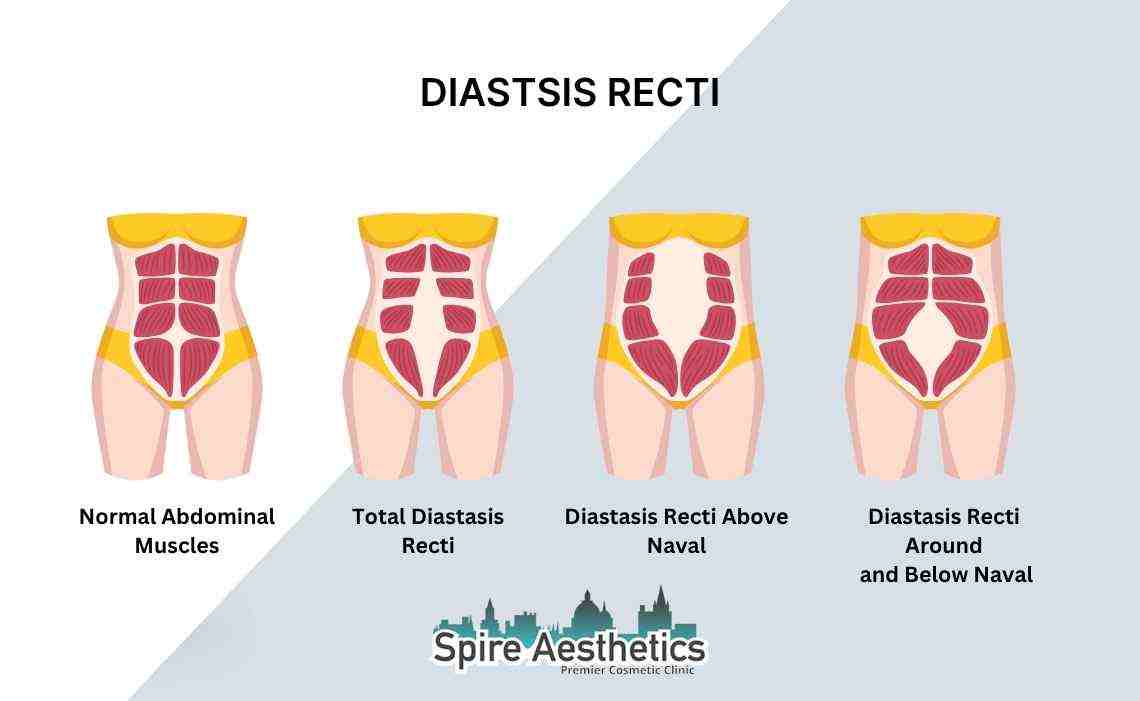 Is Non-Surgical Diastasis Recti Treatment Right for You? Common Concerns Answered Wakefield